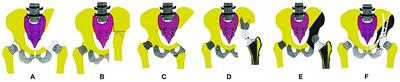 Microwave Ablation of Primary Malignant Pelvic Bone Tumors